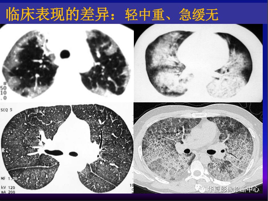 影像PPT - 【PPT】肺间质性疾病来源、解剖、病理和影像-65