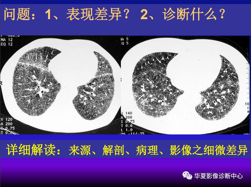 影像PPT - 【PPT】肺间质性疾病来源、解剖、病理和影像-67