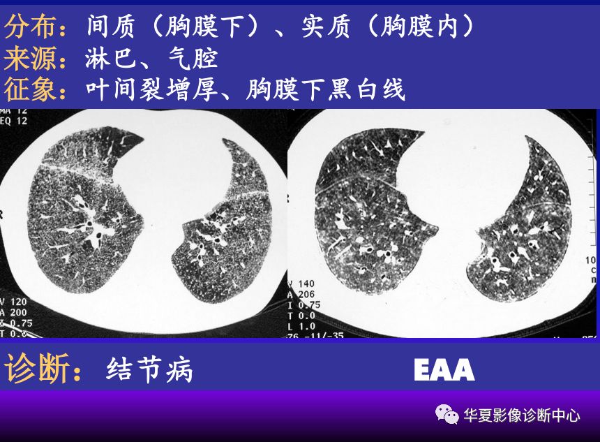 影像PPT - 【PPT】肺间质性疾病来源、解剖、病理和影像-68