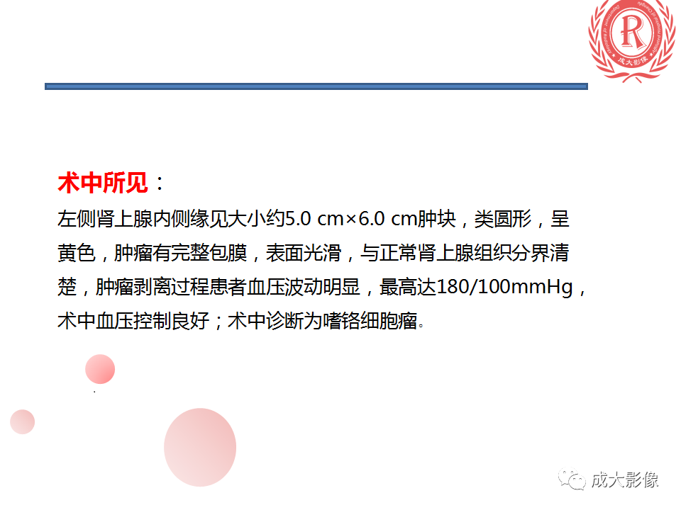 影像PPT - 【PPT】肾上腺碰撞瘤-4