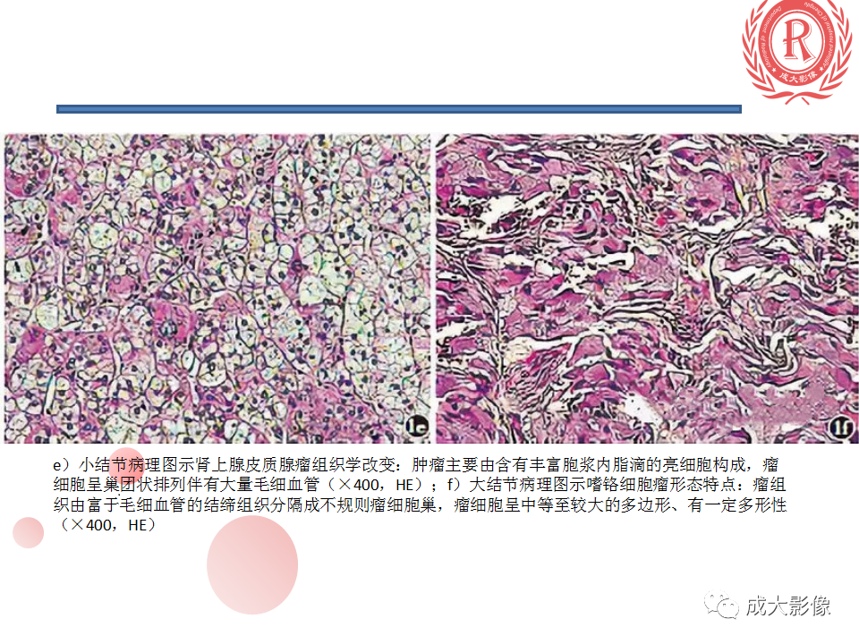 影像PPT - 【PPT】肾上腺碰撞瘤-6