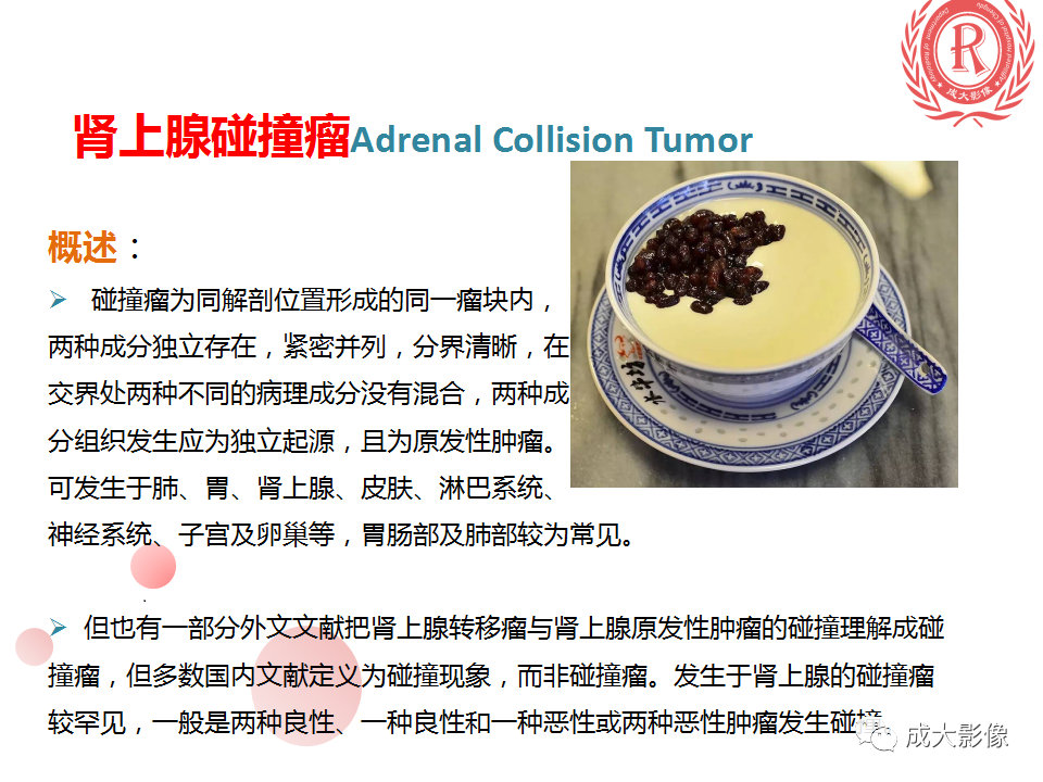 影像PPT - 【PPT】肾上腺碰撞瘤-7