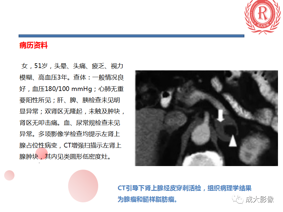 影像PPT - 【PPT】肾上腺碰撞瘤-13