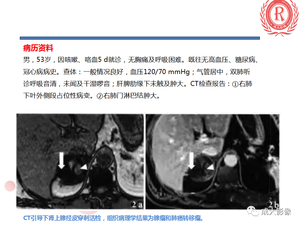 影像PPT - 【PPT】肾上腺碰撞瘤-14