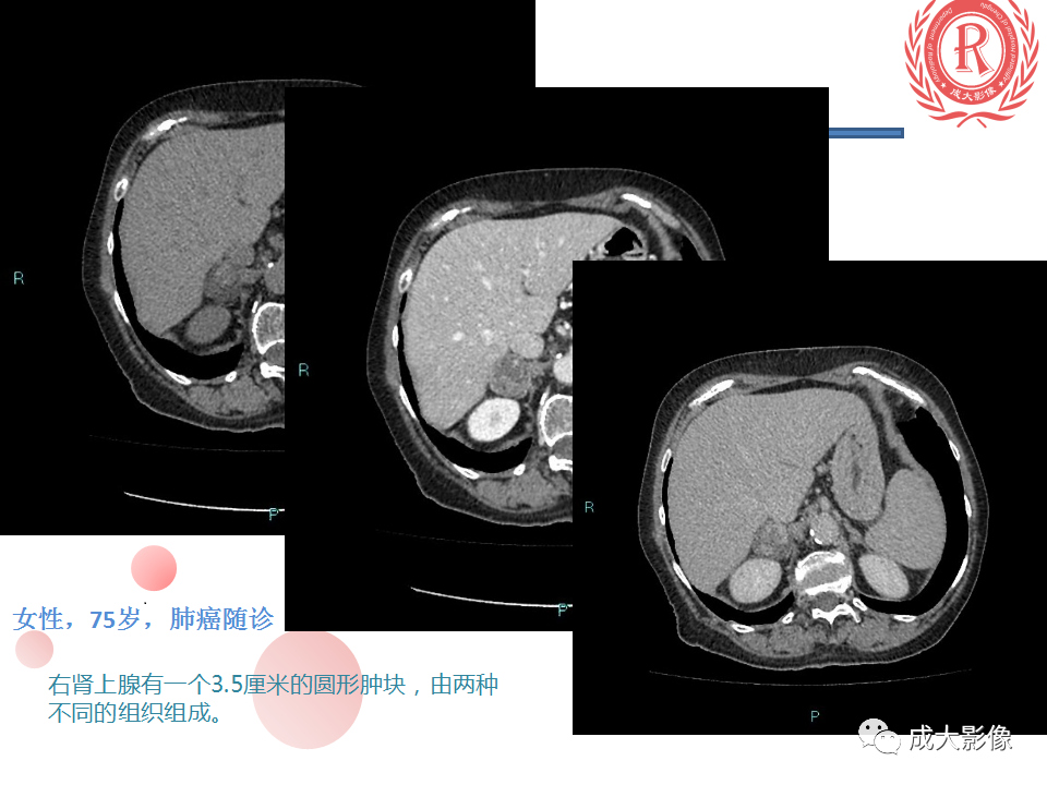影像PPT - 【PPT】肾上腺碰撞瘤-15