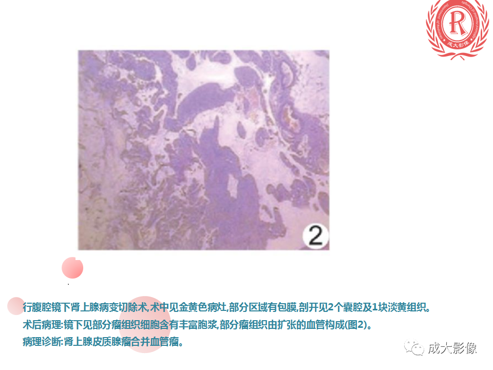 影像PPT - 【PPT】肾上腺碰撞瘤-17