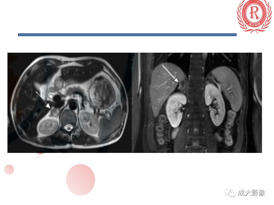 影像PPT - 【PPT】肾上腺碰撞瘤-22