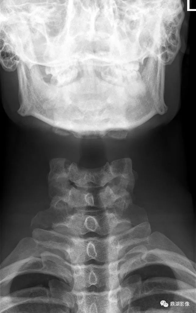 影像PPT - 【病例】消失的颈椎(Vertebral aplasia综合症)1例-2 影像PPT - 【病例】消失的颈椎(Vertebral aplasia综合症)1例-2