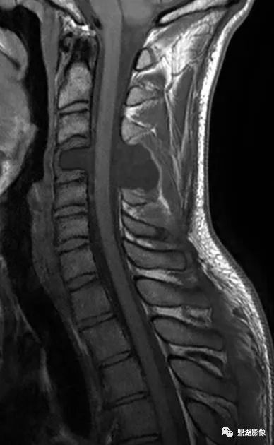 影像PPT - 【病例】消失的颈椎(Vertebral aplasia综合症)1例-5 影像PPT - 【病例】消失的颈椎(Vertebral aplasia综合症)1例-5