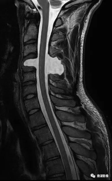 影像PPT - 【病例】消失的颈椎(Vertebral aplasia综合症)1例-6 影像PPT - 【病例】消失的颈椎(Vertebral aplasia综合症)1例-6