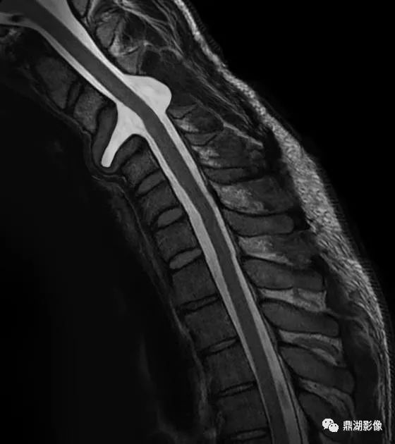 影像PPT - 【病例】消失的颈椎(Vertebral aplasia综合症)1例-1 影像PPT - 【病例】消失的颈椎(Vertebral aplasia综合症)1例-1