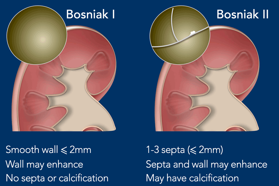 影像PPT - 肾囊性病变Bosniak分类-1 影像PPT - 肾囊性病变Bosniak分类-1