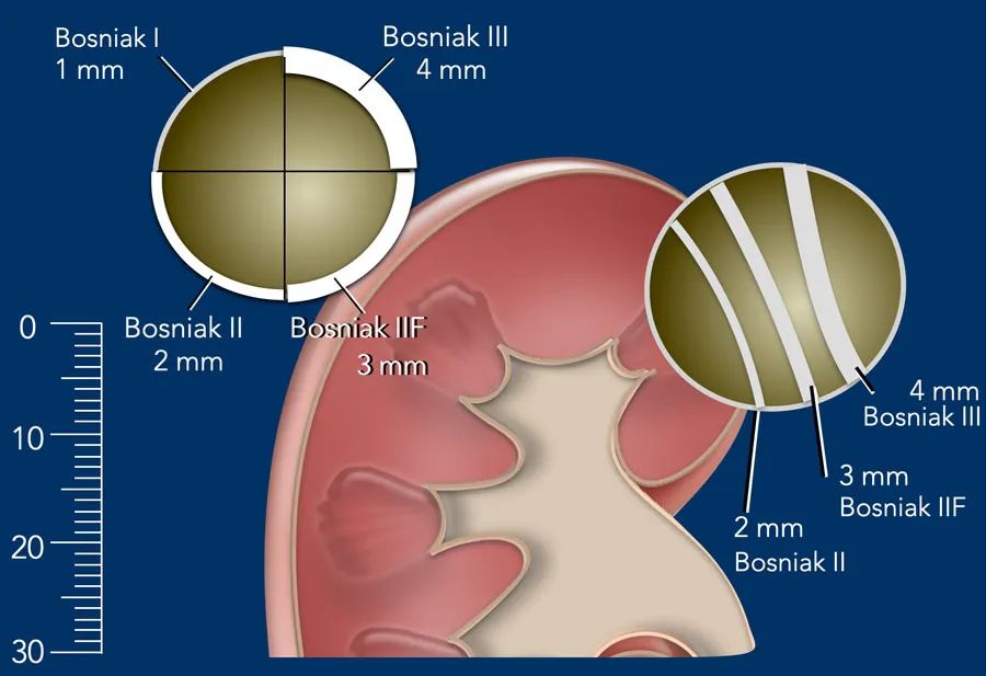 影像PPT - 肾囊性病变Bosniak分类-7 影像PPT - 肾囊性病变Bosniak分类-7