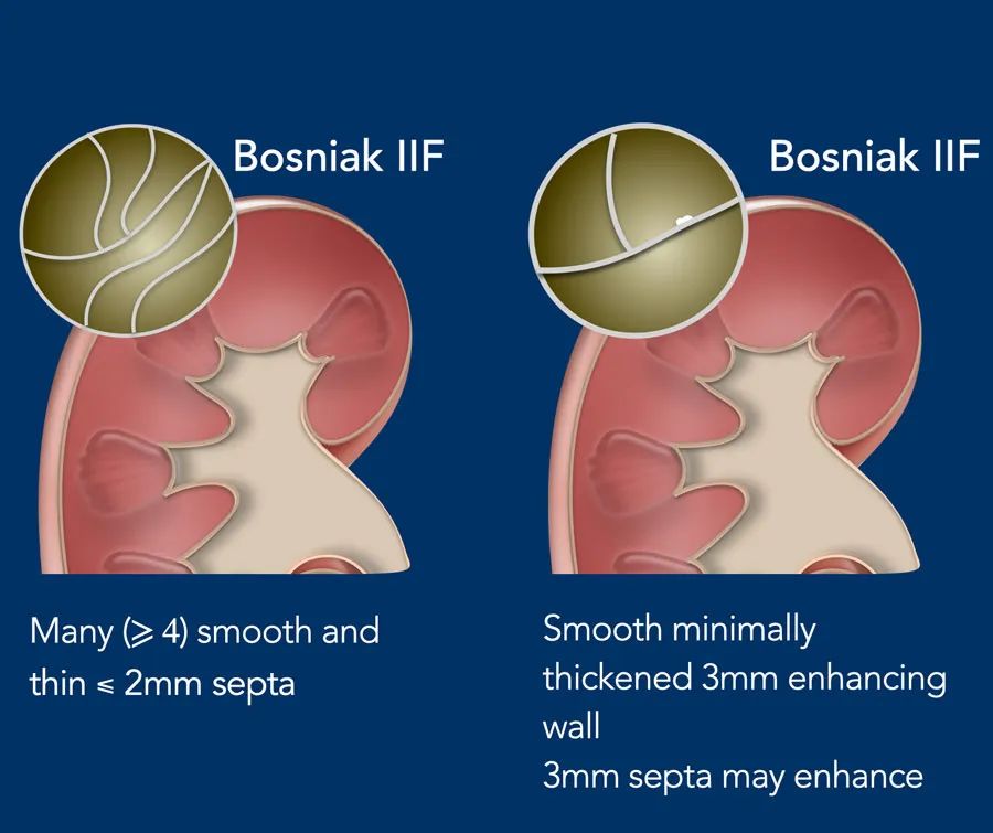 影像PPT - 肾囊性病变Bosniak分类-2 影像PPT - 肾囊性病变Bosniak分类-2