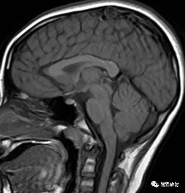 影像PPT - 【病例】巨大的蛛网膜颗粒1例MR-1 影像PPT - 【病例】巨大的蛛网膜颗粒1例MR-1