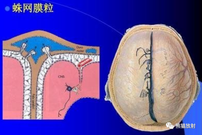 影像PPT - 【病例】巨大的蛛网膜颗粒1例MR-4 影像PPT - 【病例】巨大的蛛网膜颗粒1例MR-4