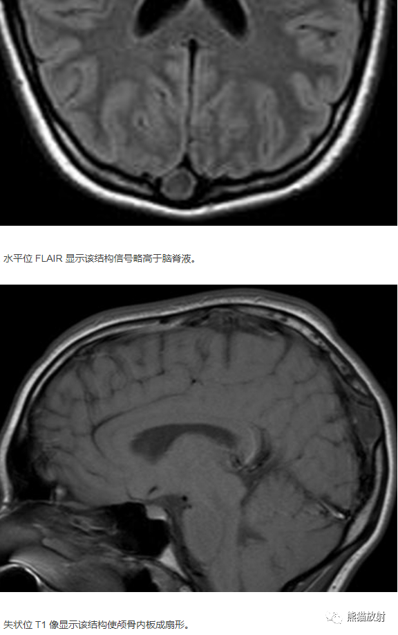 影像PPT - 【病例】巨大的蛛网膜颗粒1例MR-11 影像PPT - 【病例】巨大的蛛网膜颗粒1例MR-11