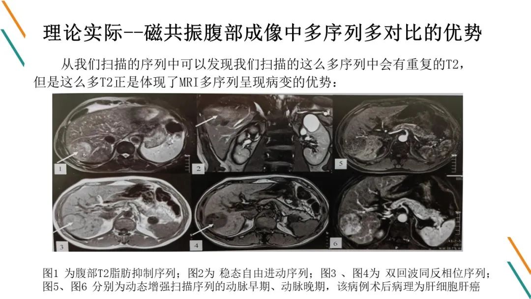 影像PPT - 【PPT】腹部MRI扫描、增强期相及延迟扫描策略-25