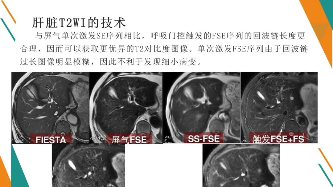 影像PPT - 【PPT】腹部MRI扫描、增强期相及延迟扫描策略-36