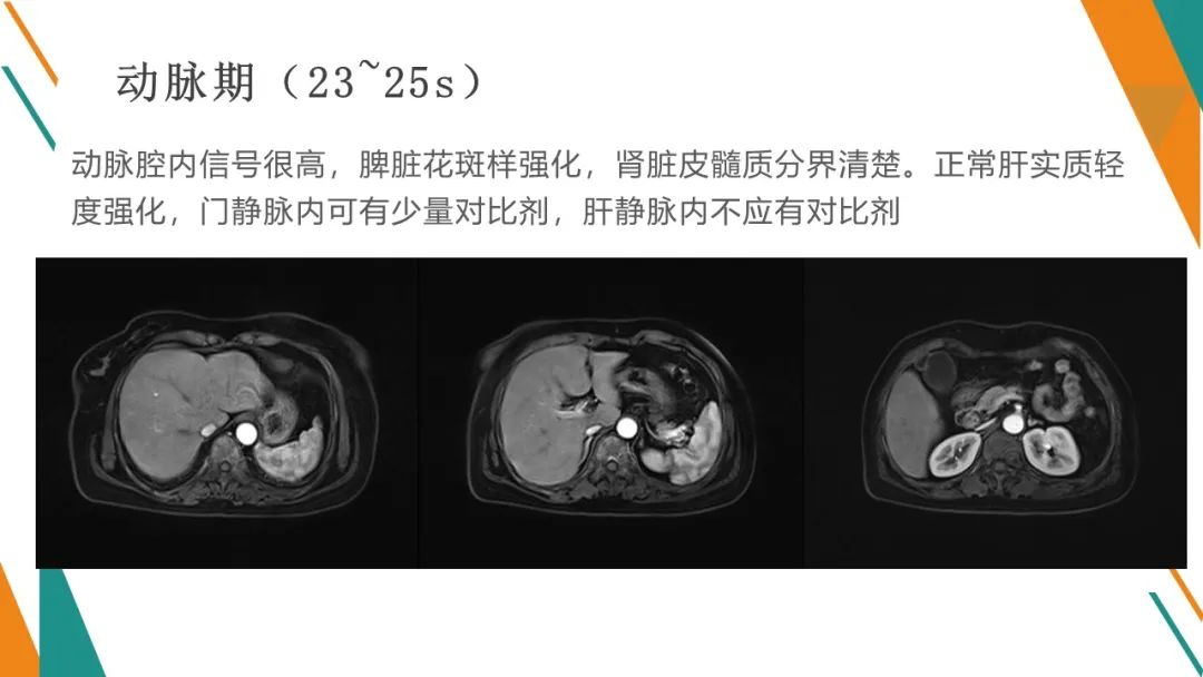 影像PPT - 【PPT】腹部MRI扫描、增强期相及延迟扫描策略-53