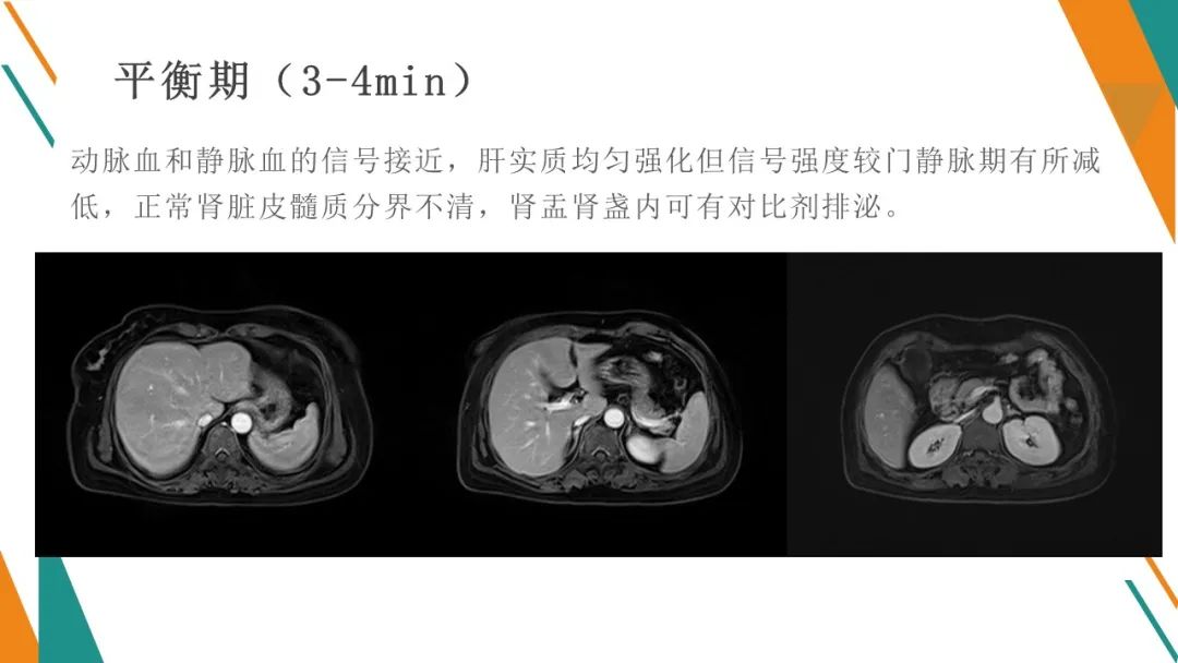 影像PPT - 【PPT】腹部MRI扫描、增强期相及延迟扫描策略-55