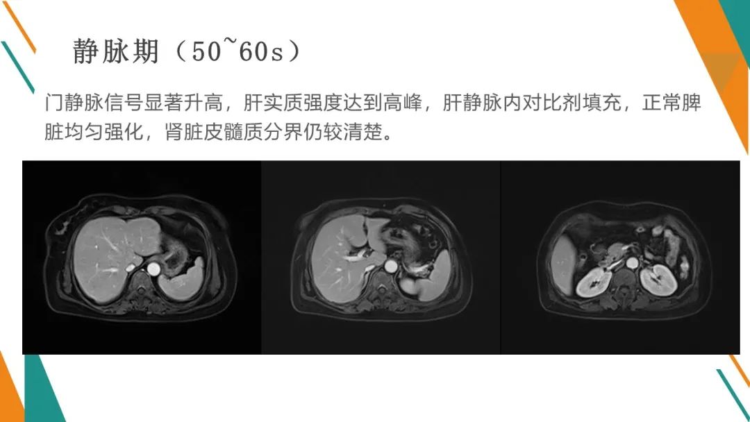 影像PPT - 【PPT】腹部MRI扫描、增强期相及延迟扫描策略-54