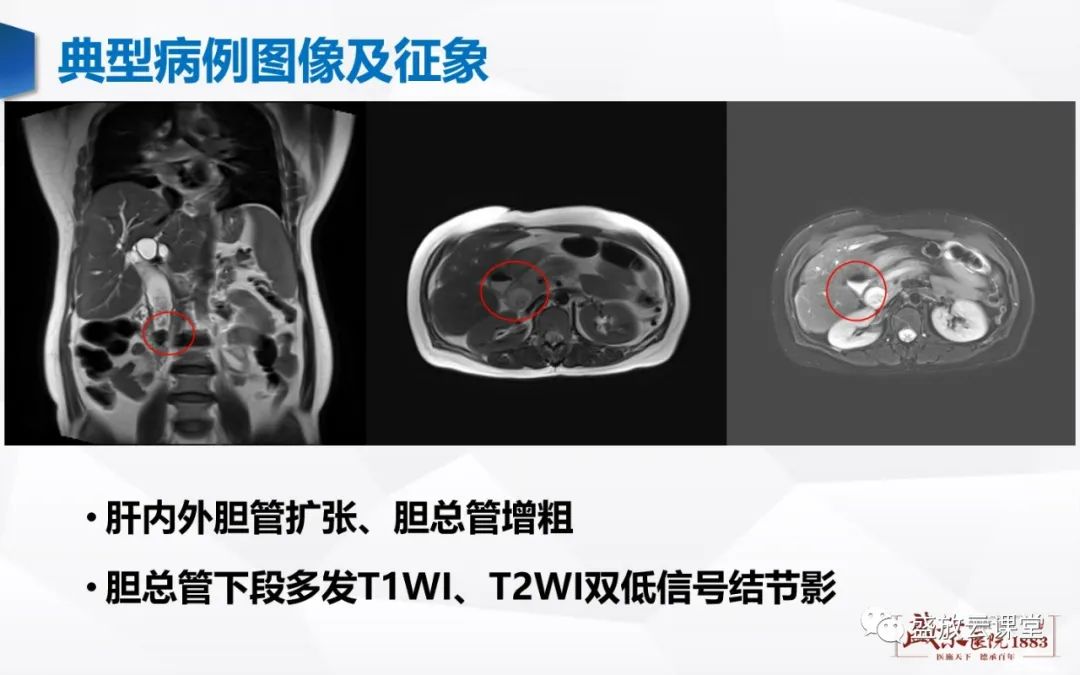 影像PPT - 【PPT】胆系病变：胆系炎症、胆系结石-9