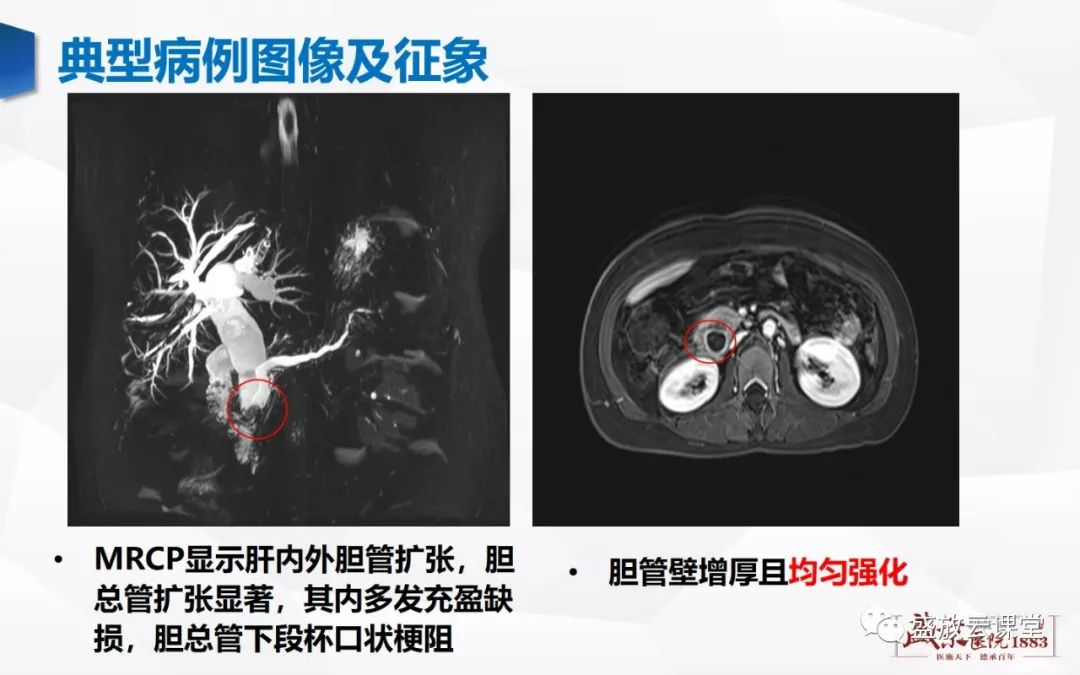 影像PPT - 【PPT】胆系病变：胆系炎症、胆系结石-10