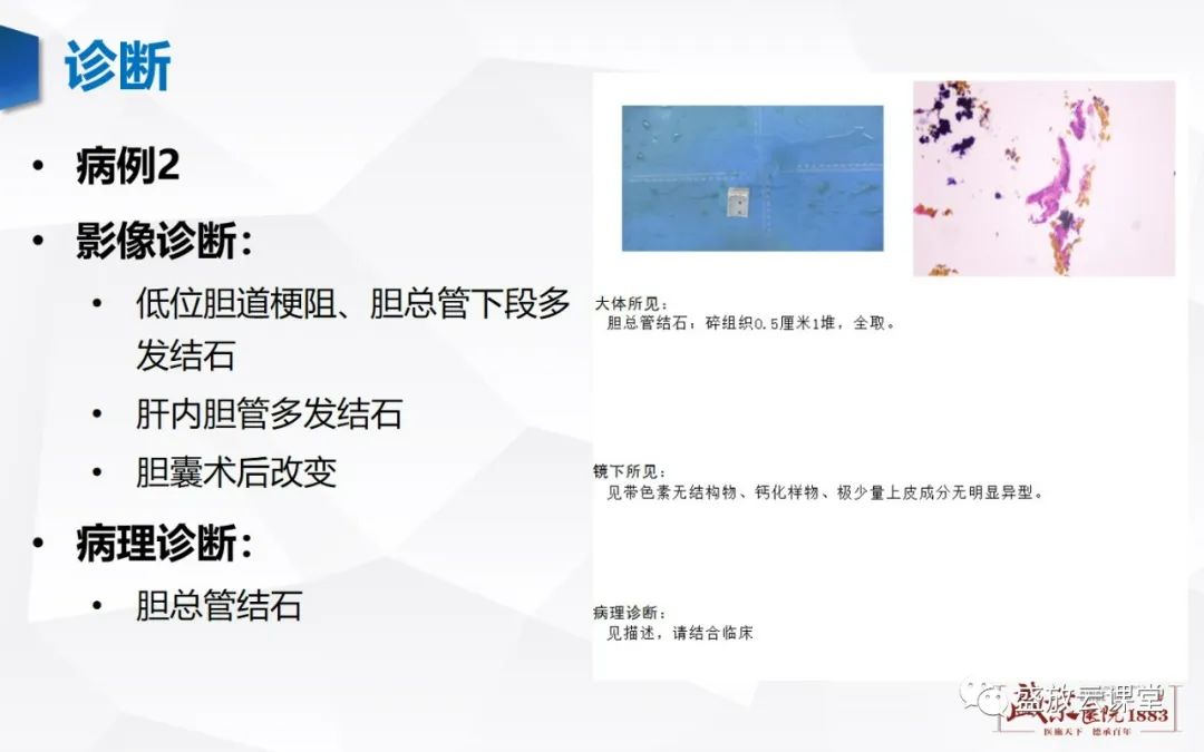 影像PPT - 【PPT】胆系病变：胆系炎症、胆系结石-13