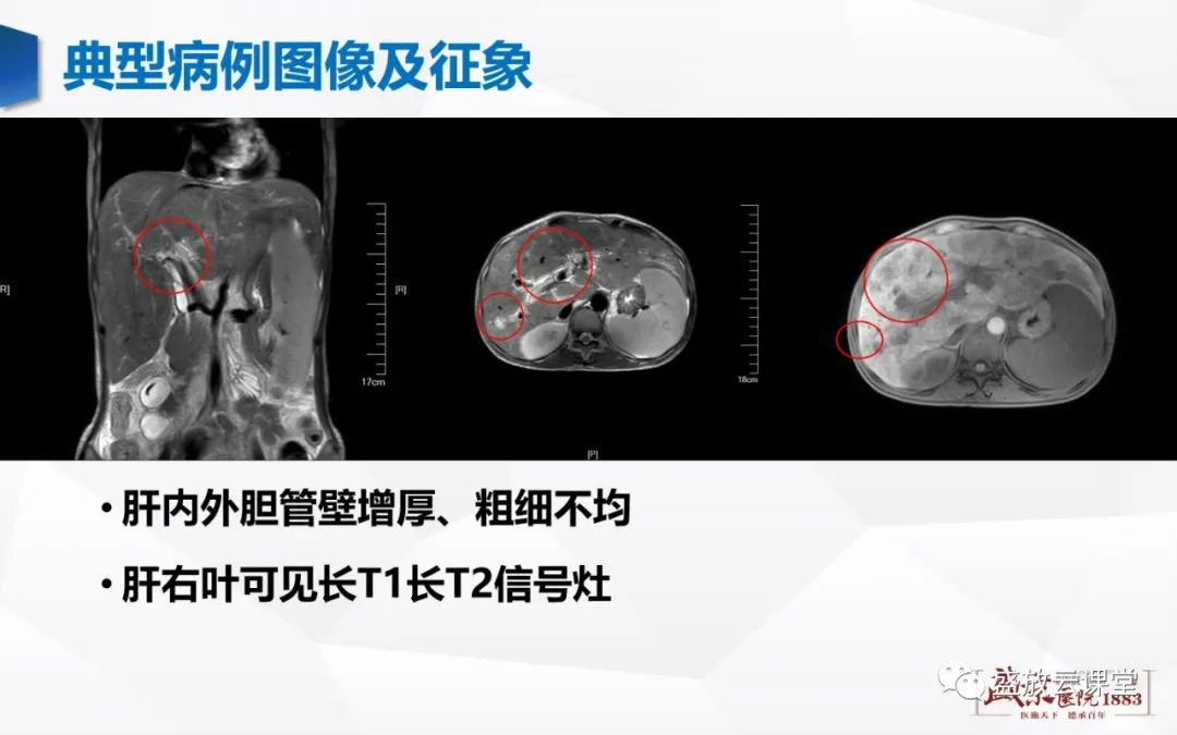 影像PPT - 【PPT】胆系病变：胆系炎症、胆系结石-15