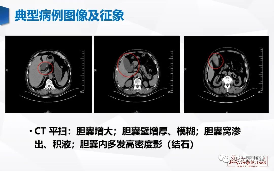 影像PPT - 【PPT】胆系病变：胆系炎症、胆系结石-4