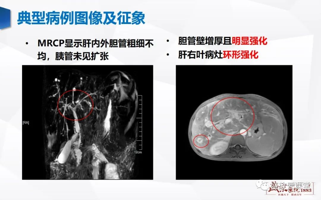 影像PPT - 【PPT】胆系病变：胆系炎症、胆系结石-16