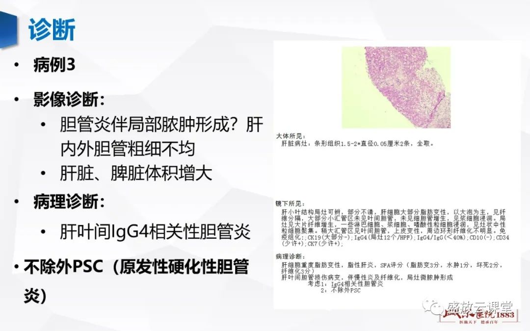 影像PPT - 【PPT】胆系病变：胆系炎症、胆系结石-19