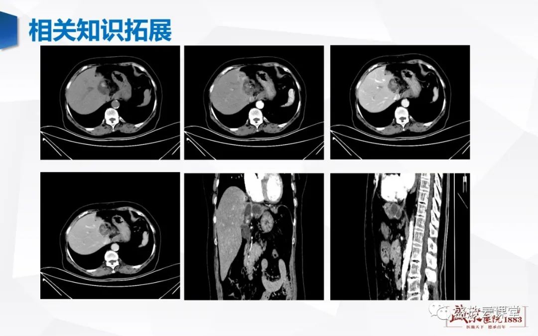 影像PPT - 【PPT】胆系病变：胆系炎症、胆系结石-25