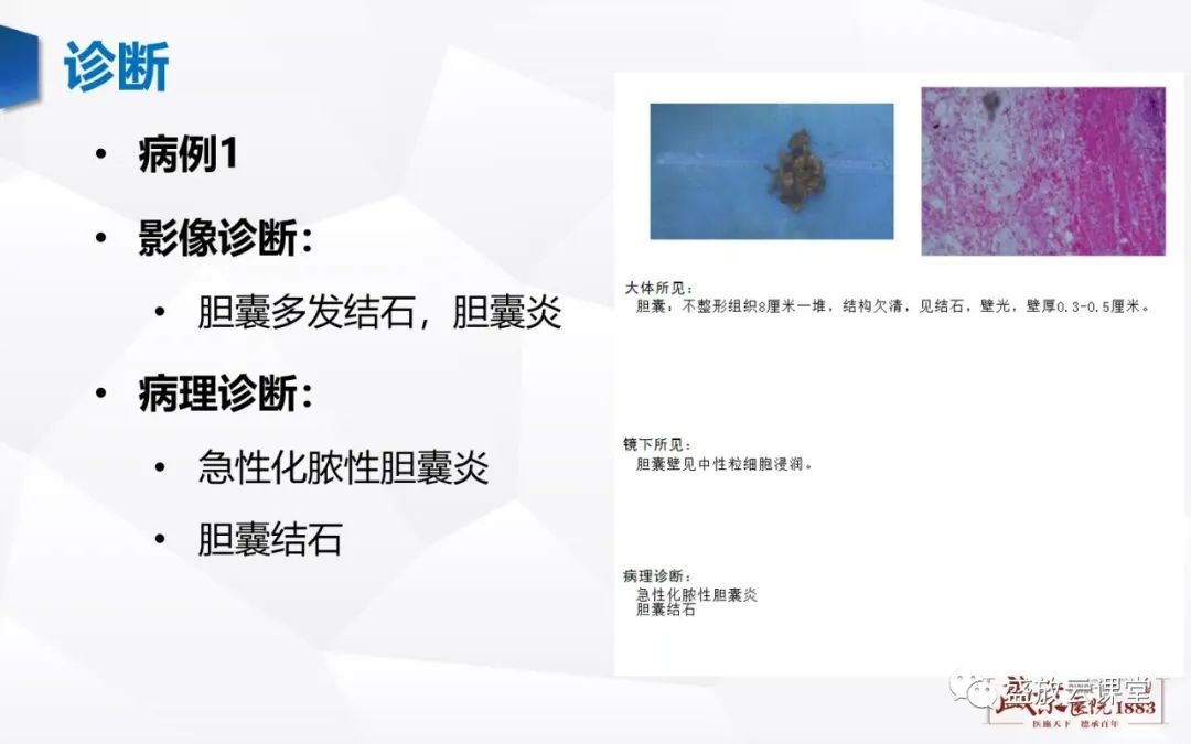 影像PPT - 【PPT】胆系病变：胆系炎症、胆系结石-7