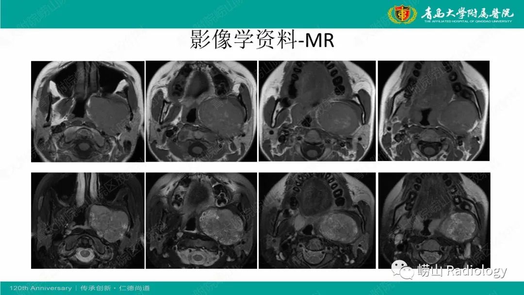 影像PPT - 【病例】多形性腺瘤1例CT及MR-4