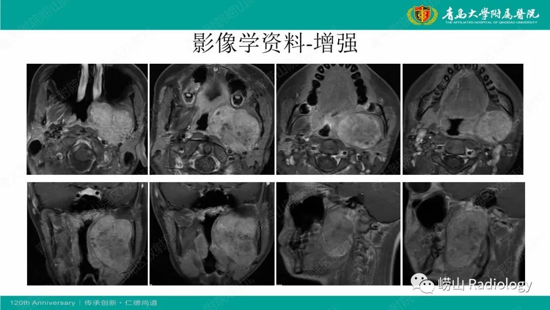 影像PPT - 【病例】多形性腺瘤1例CT及MR-5