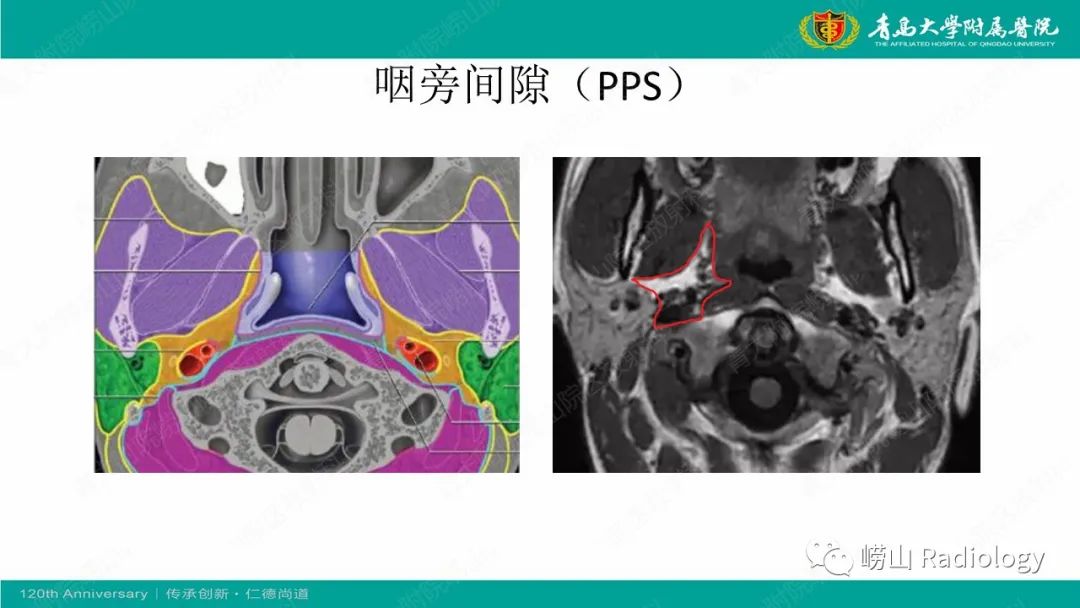 影像PPT - 【病例】多形性腺瘤1例CT及MR-9