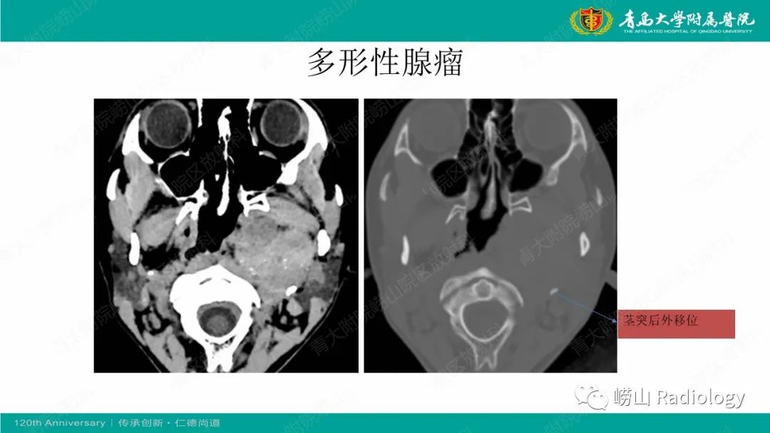 影像PPT - 【病例】多形性腺瘤1例CT及MR-12