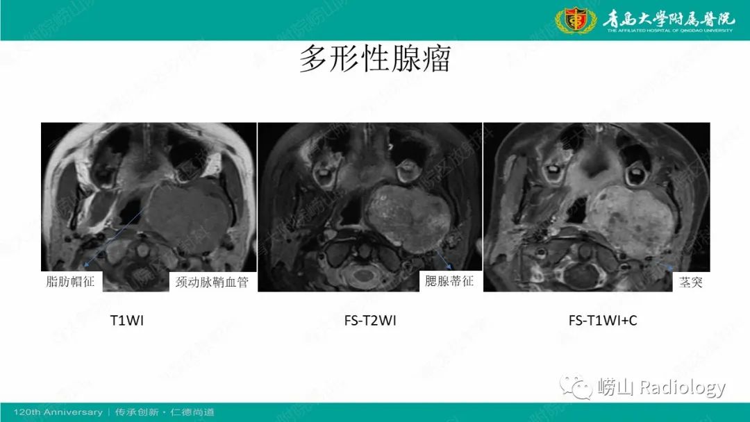 影像PPT - 【病例】多形性腺瘤1例CT及MR-13