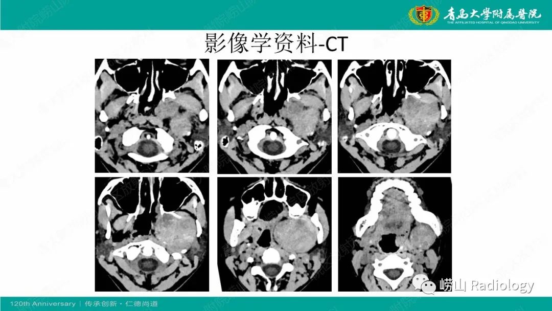 影像PPT - 【病例】多形性腺瘤1例CT及MR-3