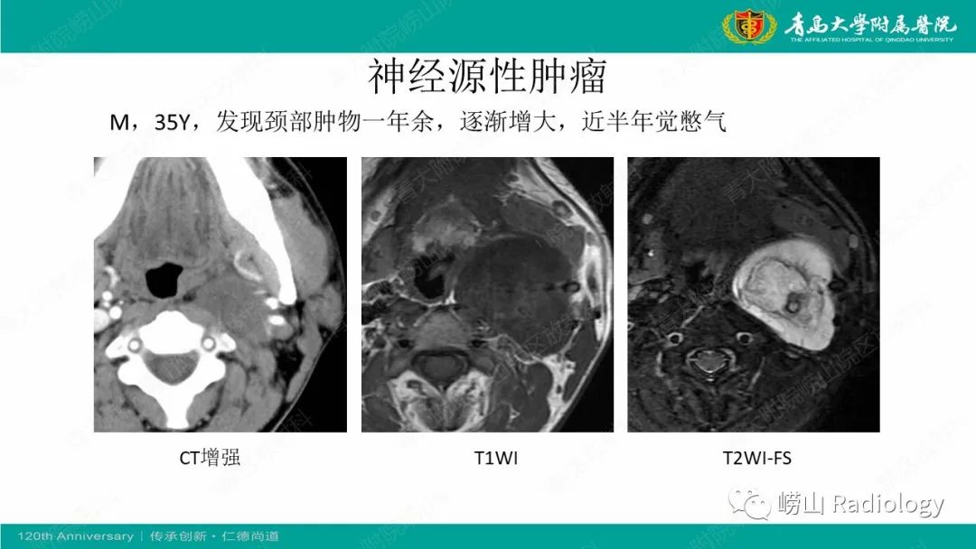 影像PPT - 【病例】多形性腺瘤1例CT及MR-16