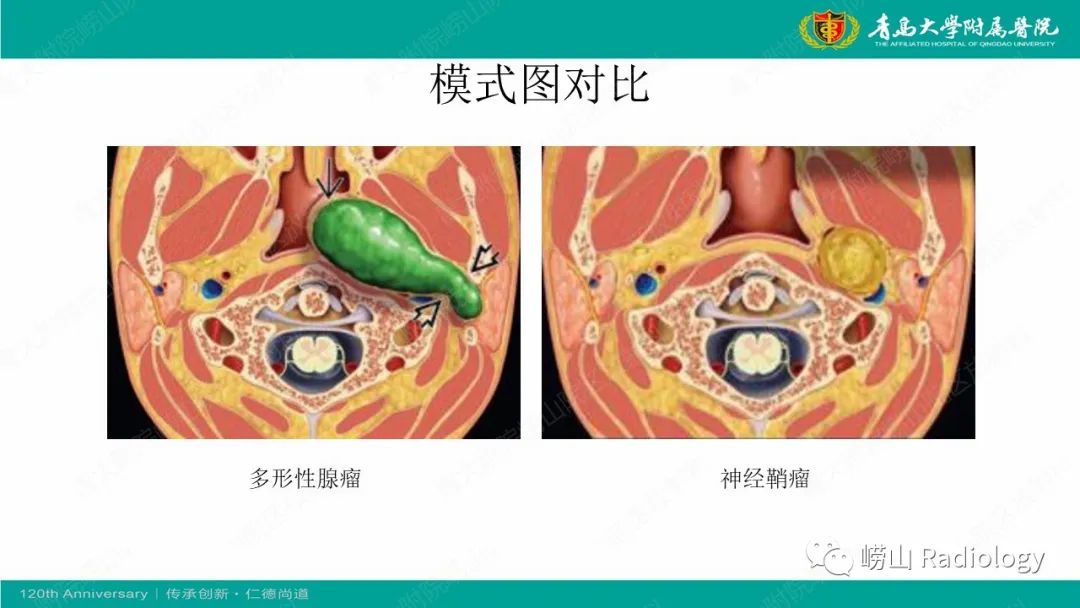 影像PPT - 【病例】多形性腺瘤1例CT及MR-17