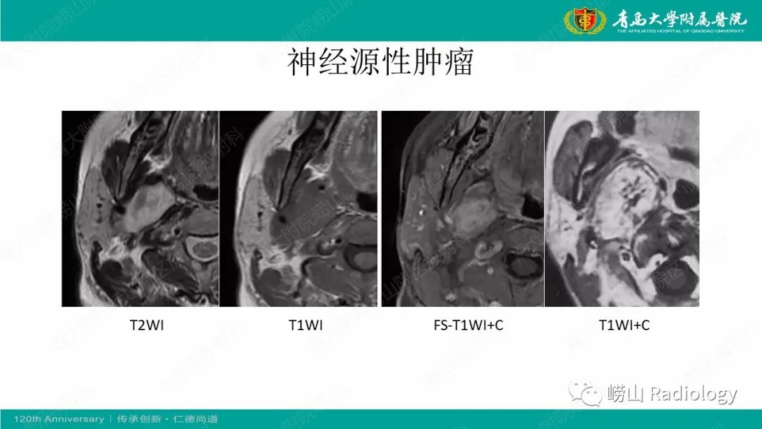 影像PPT - 【病例】多形性腺瘤1例CT及MR-15