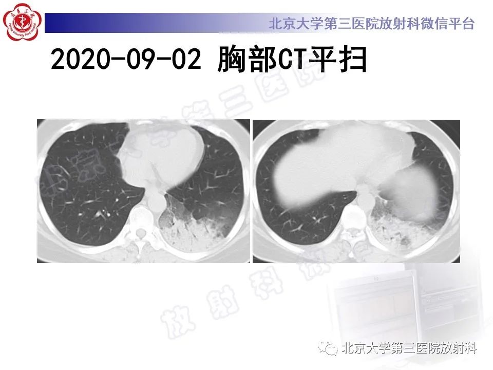 影像PPT - 【PPT】机化性肺炎-3