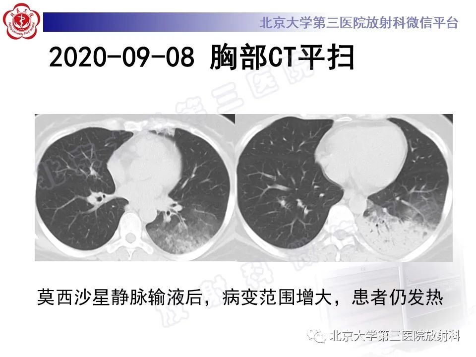 影像PPT - 【PPT】机化性肺炎-4