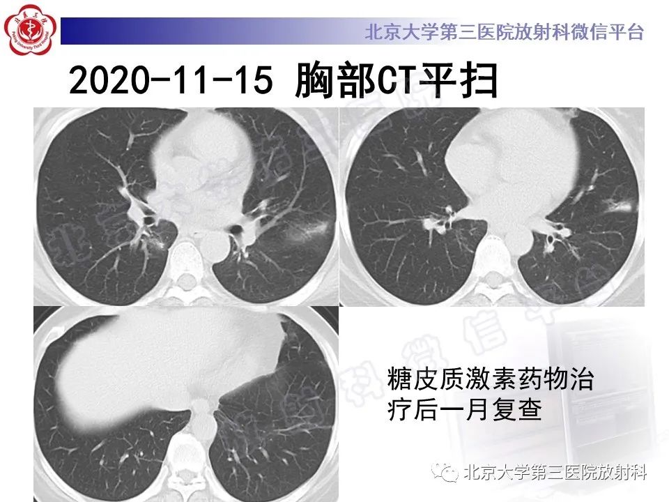 影像PPT - 【PPT】机化性肺炎-7
