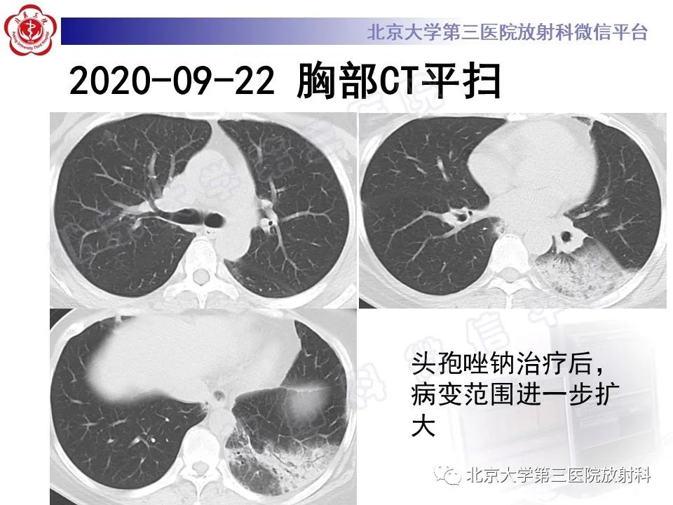 影像PPT - 【PPT】机化性肺炎-5