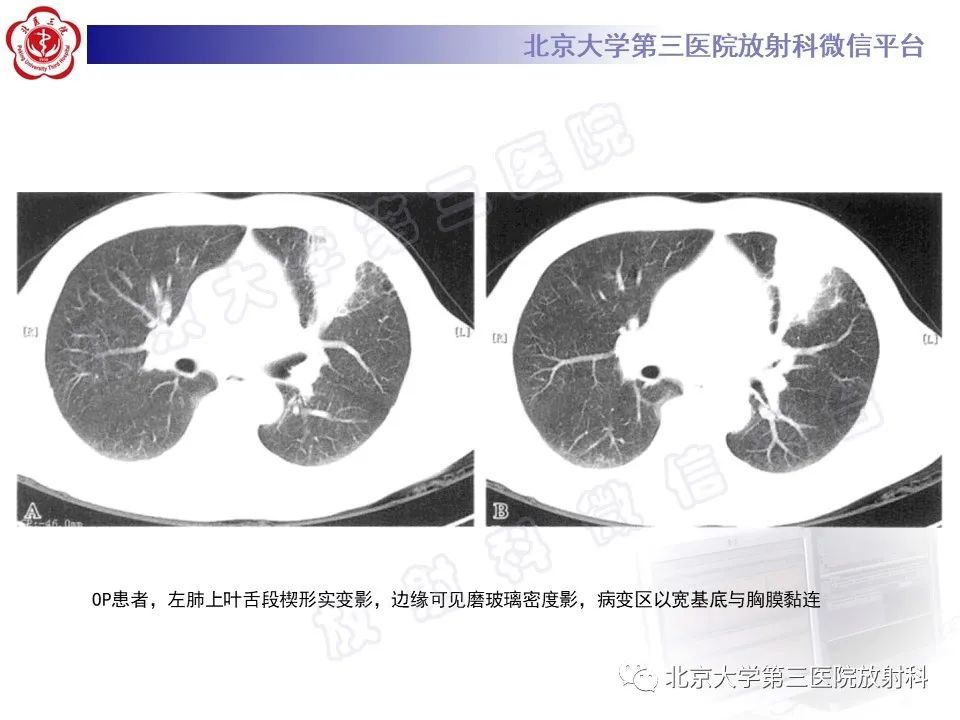 影像PPT - 【PPT】机化性肺炎-18