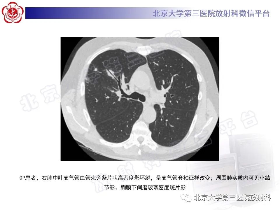 影像PPT - 【PPT】机化性肺炎-27